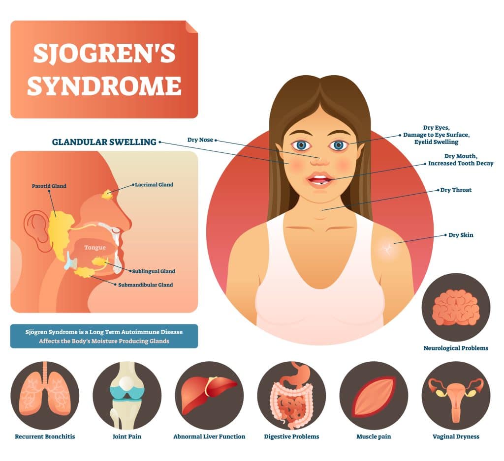 glutathione and sjogren's What Causes Sjögren's Syndrome
