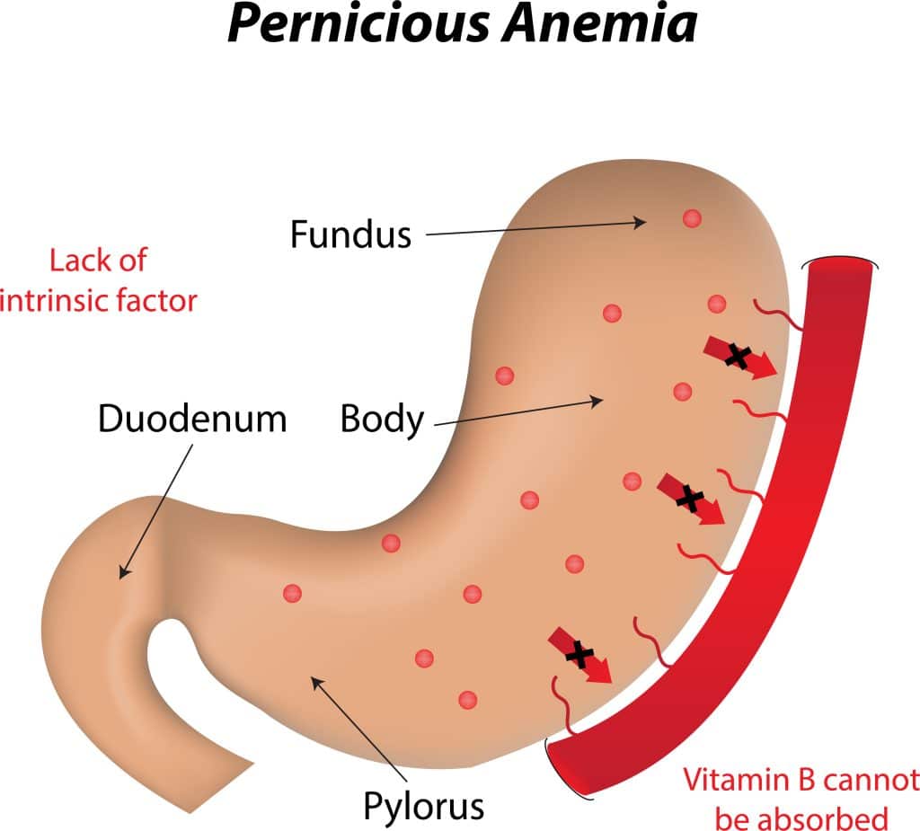 What Causes Pernicious Anemia | Pompa Program